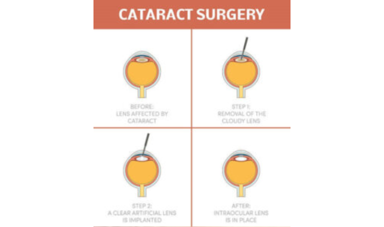 Calming Ways to Prepare for Cataract Surgery - Axis Eye Clinic