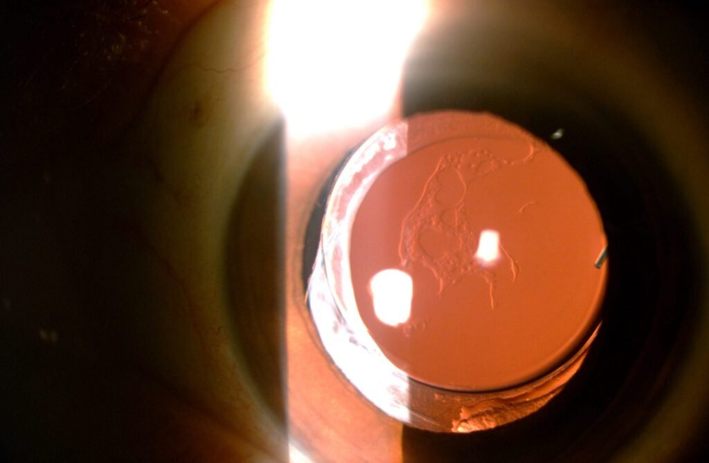 What is posterior capsular opacification?