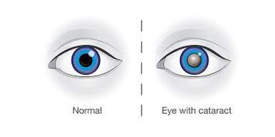 Common Tests Done Before Cataract Surgery