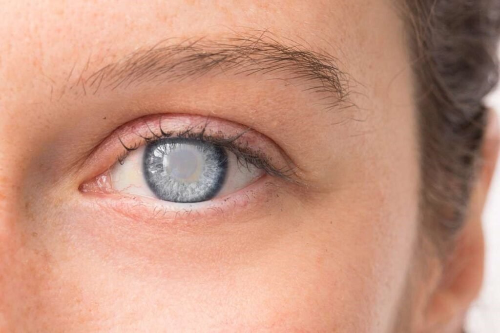 Know More About Cataracts: Causes, Symptoms, and Advanced Treatments