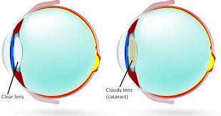 What Is Considered Strenuous Activity After Cataract Surgery?