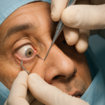 Find Cataract & Squint Treatment in pune
