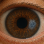 Get Blue Light and Eye Health treatment in pune