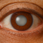 Find Best Cataract Surgeon for You