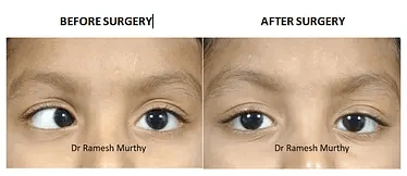 Find Squint Surgery in pune